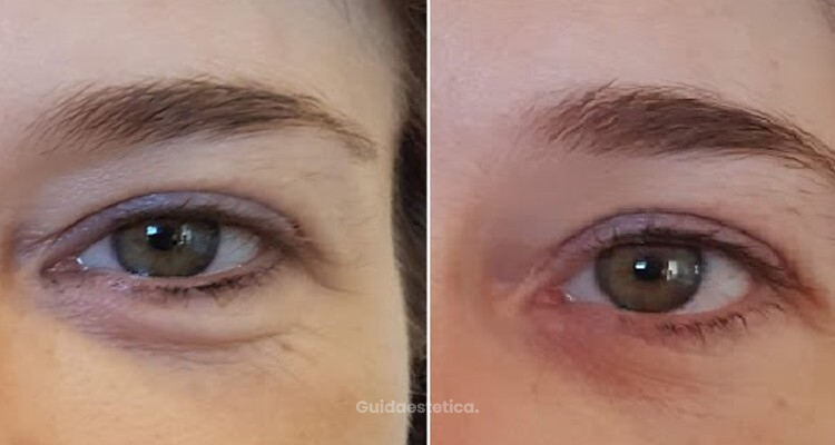 Trattamento dell'area perioculare