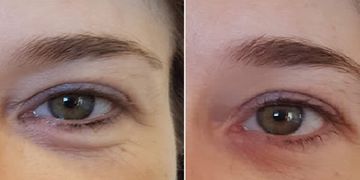 Trattamento dell'area perioculare