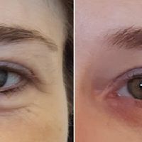 Trattamento dell'area perioculare