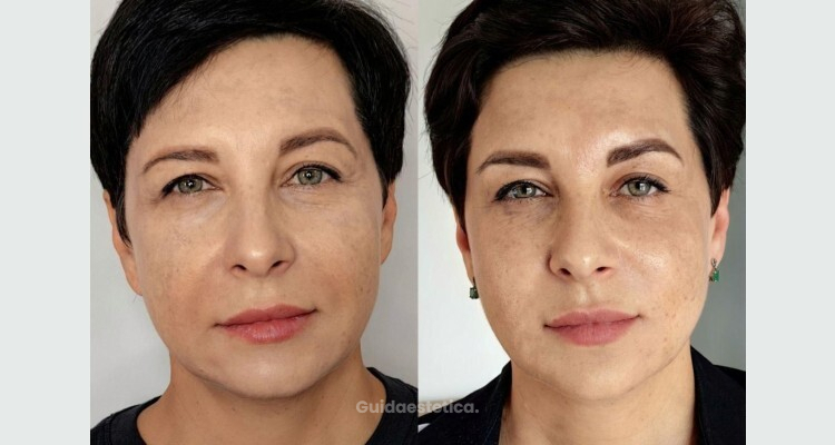 Profhilo Structura: un approccio evoluto per ridefinire i volumi del viso in modo armonico e naturale