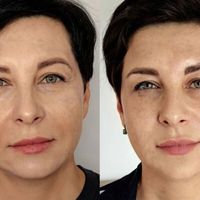 Profhilo Structura: un approccio evoluto per ridefinire i volumi del viso in modo armonico e naturale