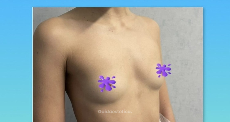 Preservè: la nuova mastoplastica additiva mini invasiva