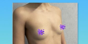 Preservè: la nuova mastoplastica additiva mini invasiva Preservè: la nuova mastoplastica additiva mini invasiva