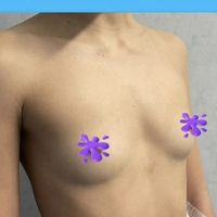 Preservè: la nuova mastoplastica additiva mini invasiva