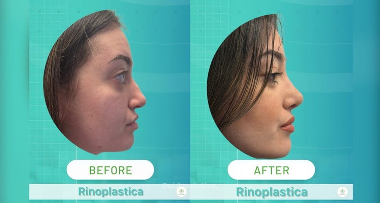 Come ottenere un risultato naturale in rinoplastica: tecnica, proporzioni, visita e recupero per un naso armonioso e mai artificiale.