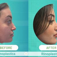 Come ottenere un risultato naturale in rinoplastica: tecnica, proporzioni, visita e recupero per un naso armonioso e mai artificiale.