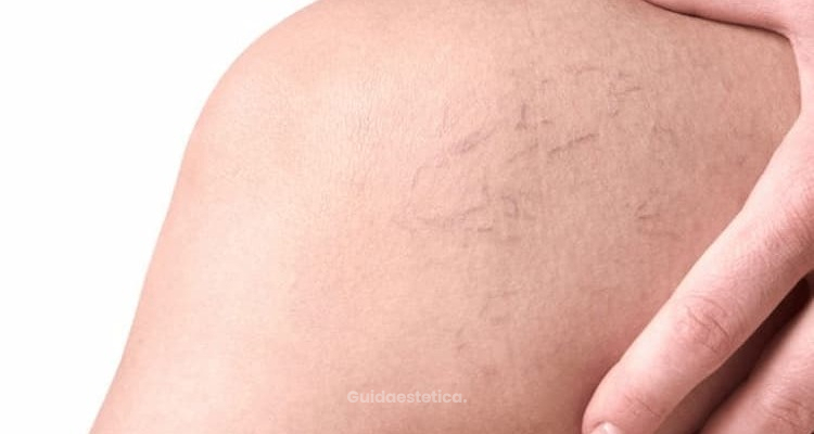 Trattamento dei capillari sulle gambe e sul corpo: diagnosi, cause e soluzioni laser