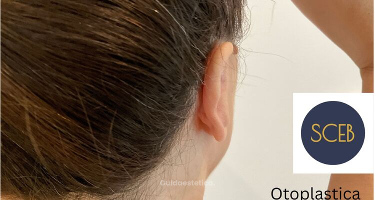 Otoplastica: correggere le orecchie prominenti con un intervento sicuro e naturale