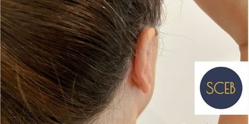 Otoplastica: correggere le orecchie prominenti con un intervento sicuro e naturale