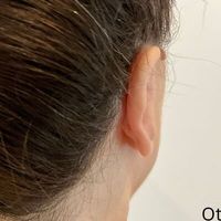 Otoplastica: correggere le orecchie prominenti con un intervento sicuro e naturale