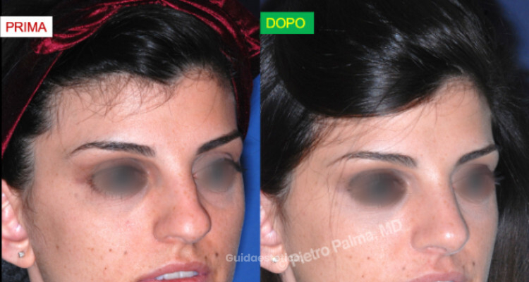 Rinoplastica naturale: come migliorare il naso senza stravolgere il viso