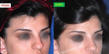 Rinoplastica naturale: come migliorare il naso senza stravolgere il viso Rinoplastica naturale: come migliorare il naso senza stravolgere il viso