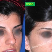 Rinoplastica naturale: come migliorare il naso senza stravolgere il viso