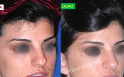 Rinoplastica naturale: come migliorare il naso senza stravolgere il viso