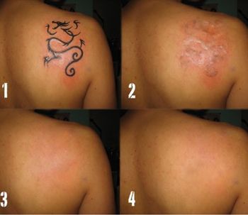 Addio tatuaggio, con
