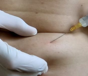 Infiltrazione del grasso con cannula