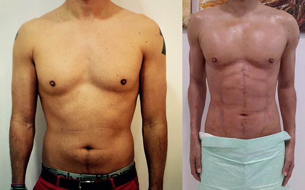 lipo-chico.jpg