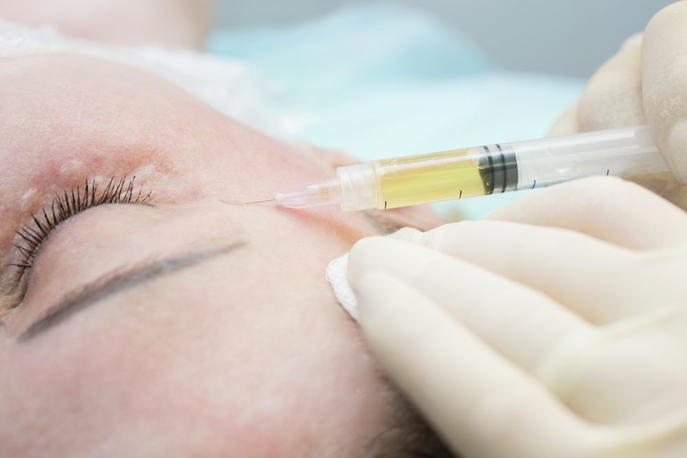 Mesobotox prima e dopo