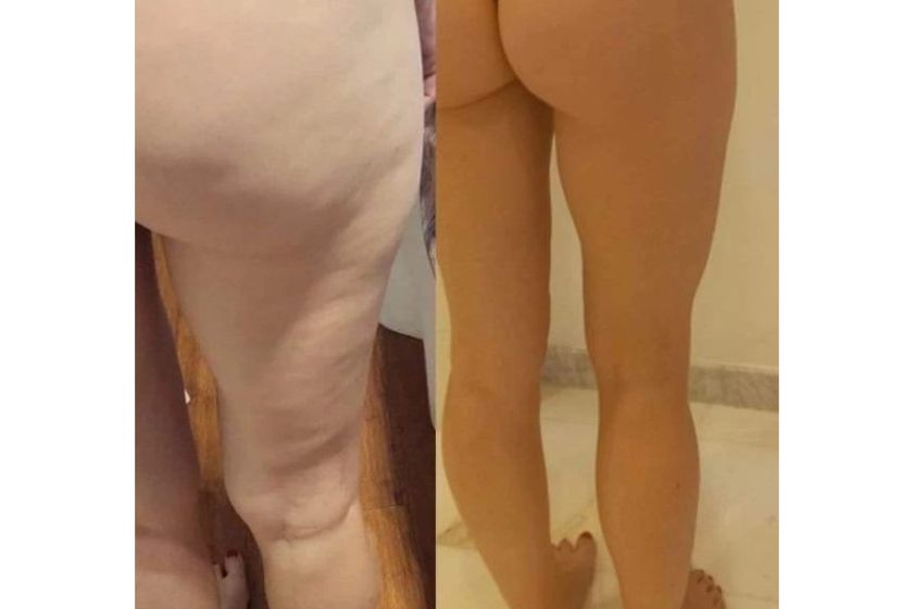 Cellulite prima e dopo - 856352
