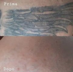 Rimozione tatuaggi - Dott. Diego Dedola