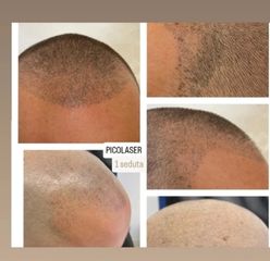 Dott. Diego Dedola pico laser rimozione