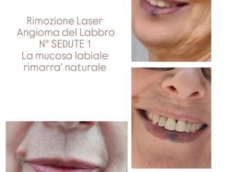 Laser CO2 frazionato prima e dopo - 874221