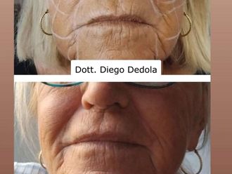 Filler prima e dopo - 874223
