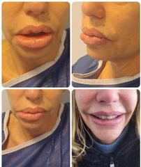 Dott. Diego Dedola Rimozione chirurgica di siliconoma della mucosa labiale