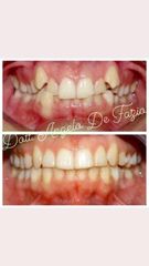 trattamento ortodontico Invisalign - Dr. Angelo De Fazio