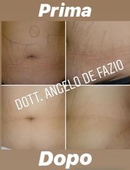 Smagliature - Dr. Angelo De Fazio
