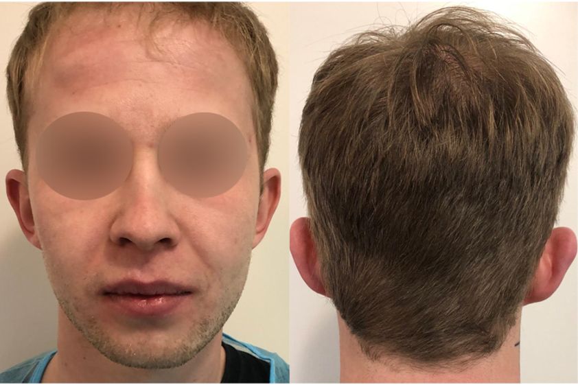 Otoplastica prima e dopo - 770921