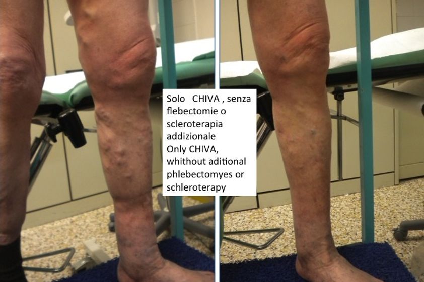Vene varicose prima e dopo - 768793