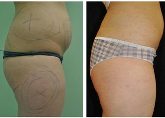 Liposuzione prima e dopo