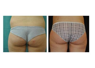 Liposuzione prima e dopo