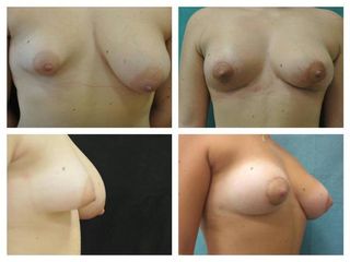 Asimmetria Mammaria prima e dopo