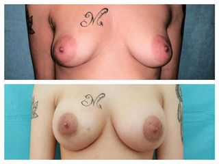 Mastopessi prima e dopo