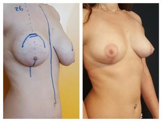 Mastopessi prima e dopo