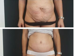 Addominoplastica prima e dopo