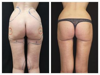 Liposcultura prima e dopo