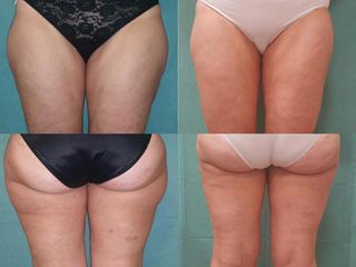 Liposuzione prima e dopo