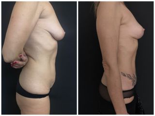 Mastopessi + lipoaddominoplastica - Dott. Stefano Di Giulio