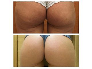 Liposcultura prima e dopo