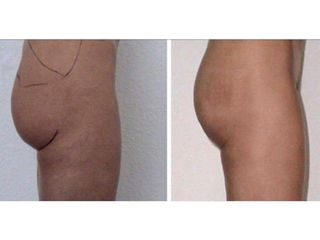 Liposcultura prima e dopo