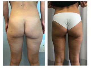 Liposuzione prima e dopo