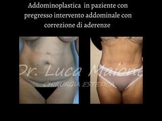 Addominoplastica - Dott. Luca Maione