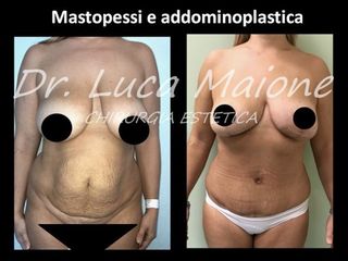 Addominoplastica - Dott. Luca Maione