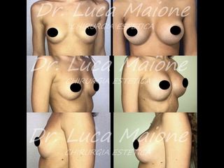 Mastoplastica additiva - Dott. Luca Maione