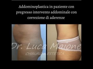 Addominoplastica - Dott. Luca Maione