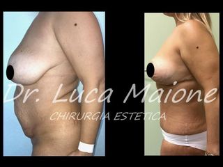 Addominoplastica - Dott. Luca Maione