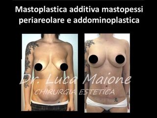 Mastoplastica additiva - Dott. Luca Maione